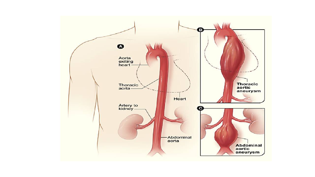 Rappresentazione di un aneurisma dell’aorta toracica