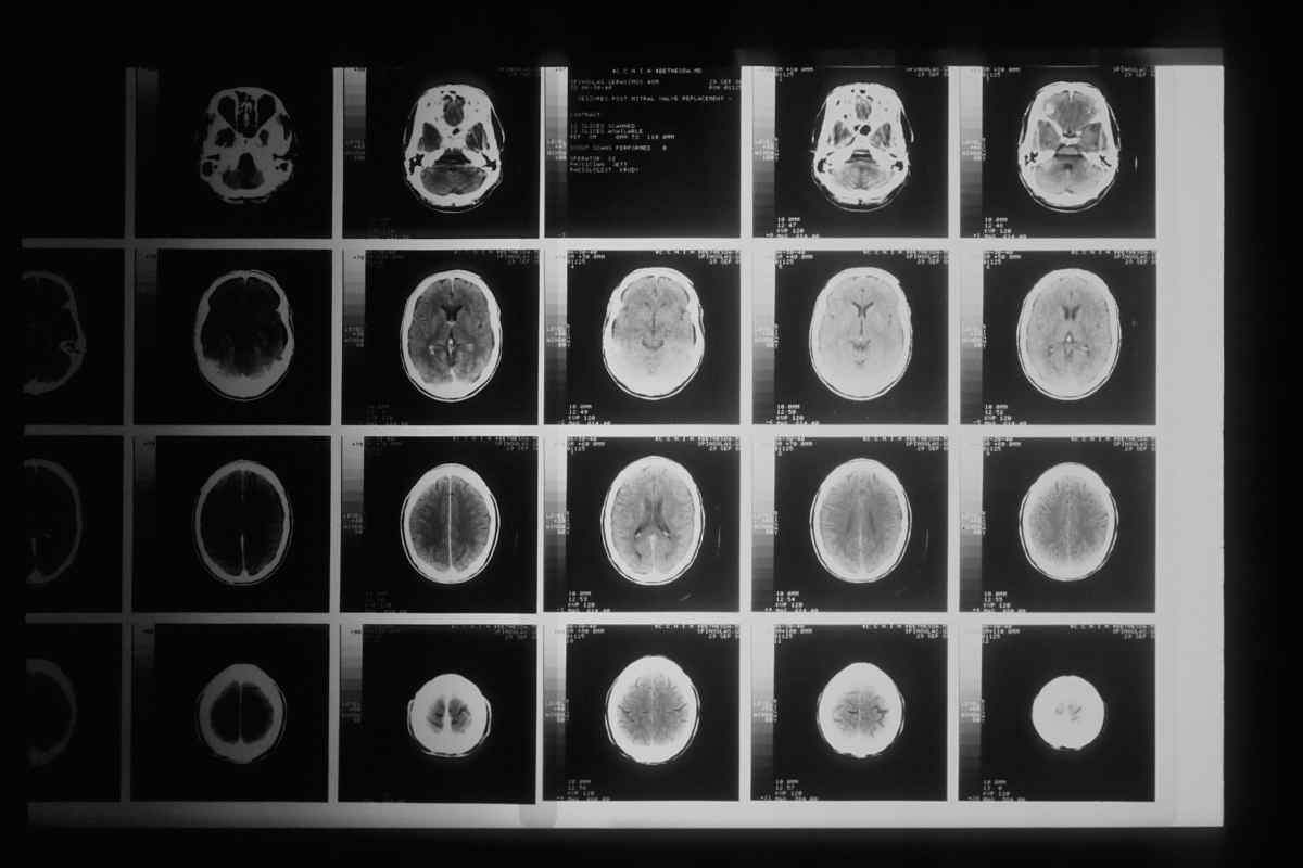 Lastre al cervello, affetto forse da glioblastoma