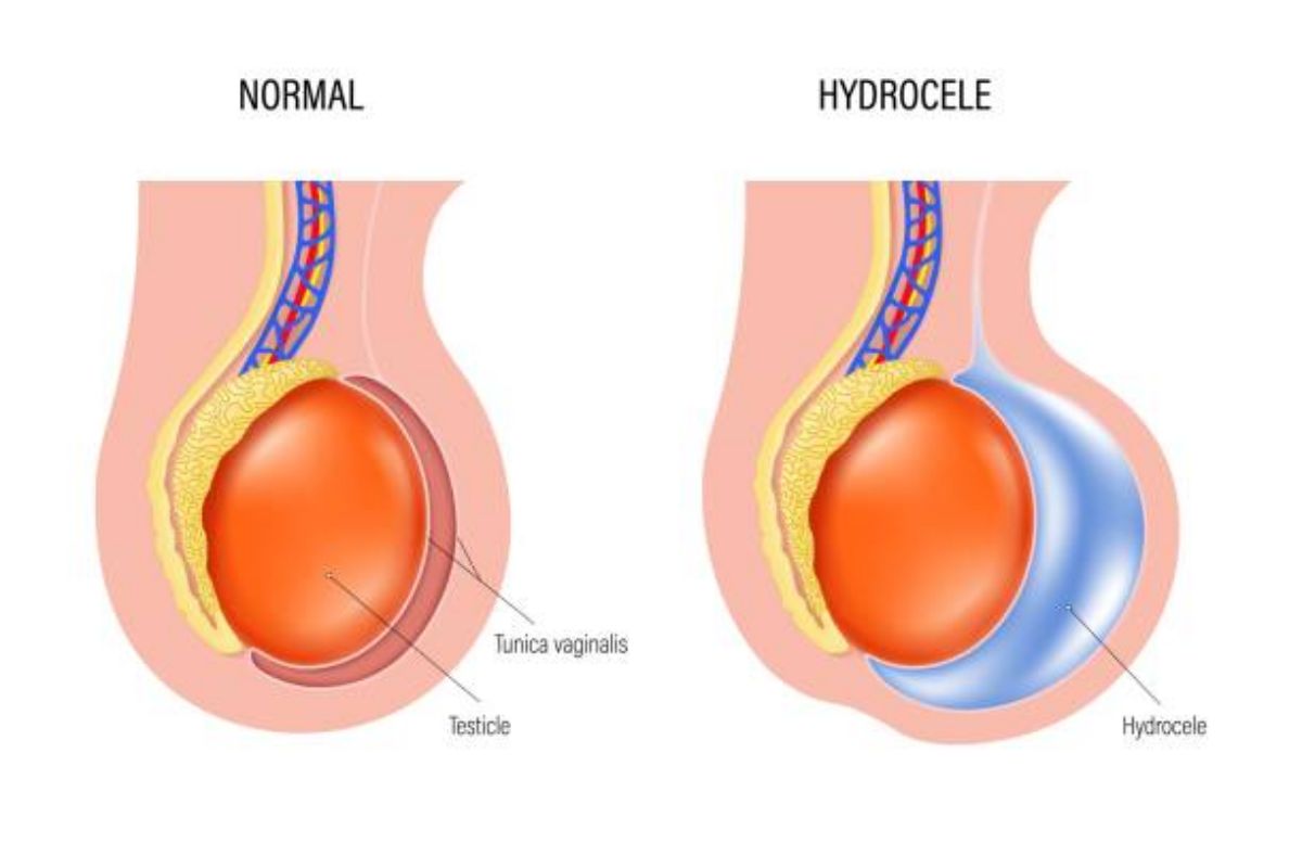 Idrocele