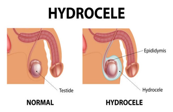 Idrocele