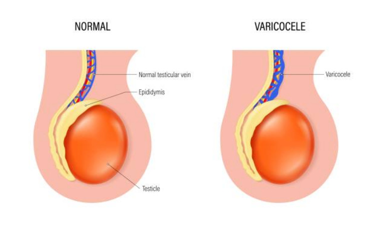 Varicocele