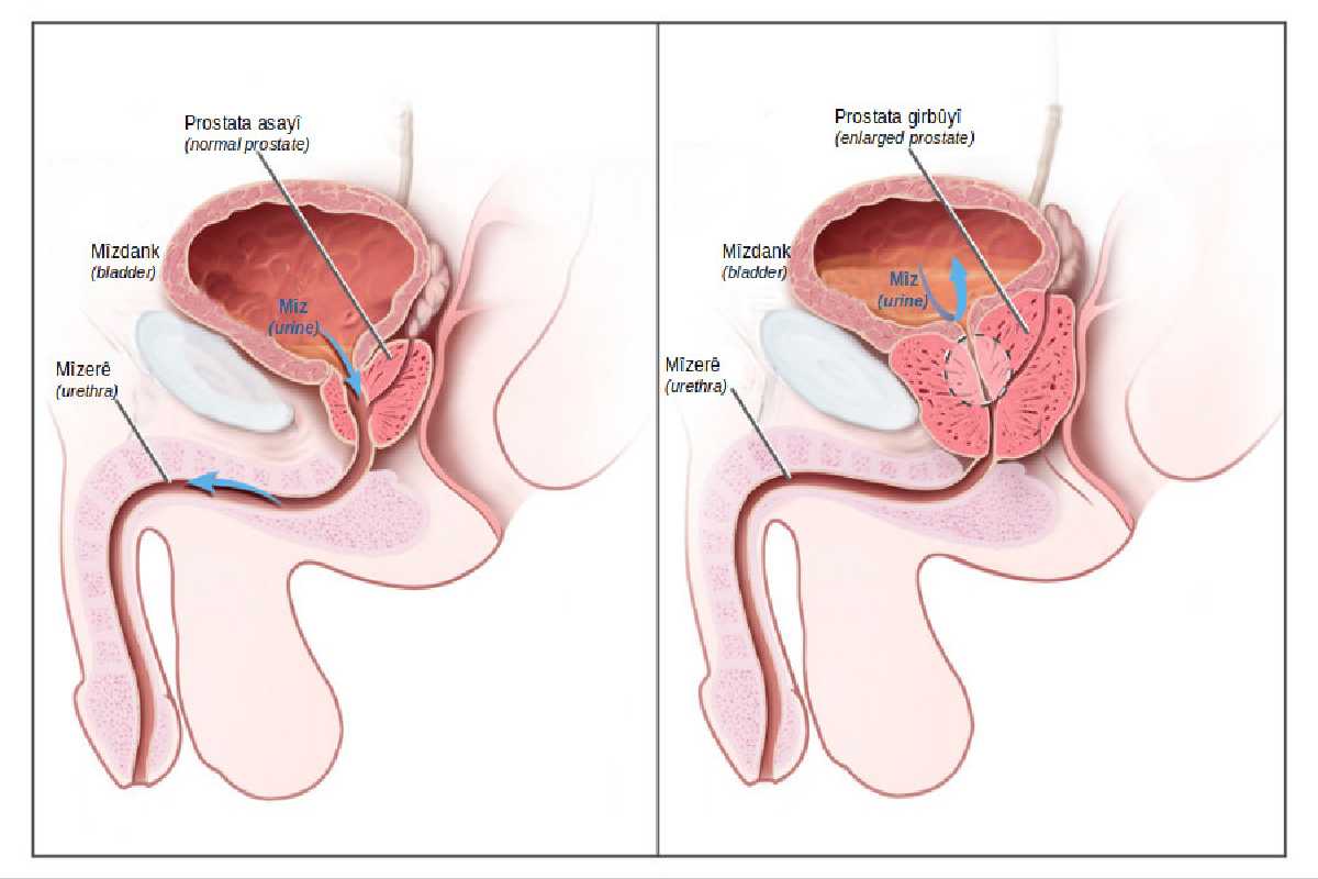 Rappresentazione di una prostata ingrossata