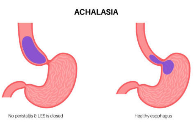 Acalasia esofagea
