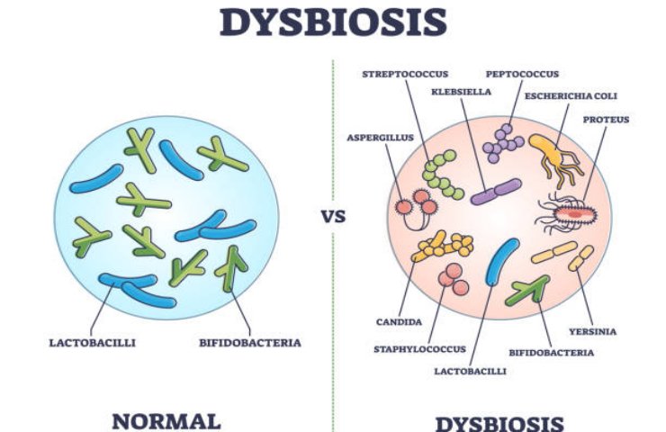 Disbosi intestinale